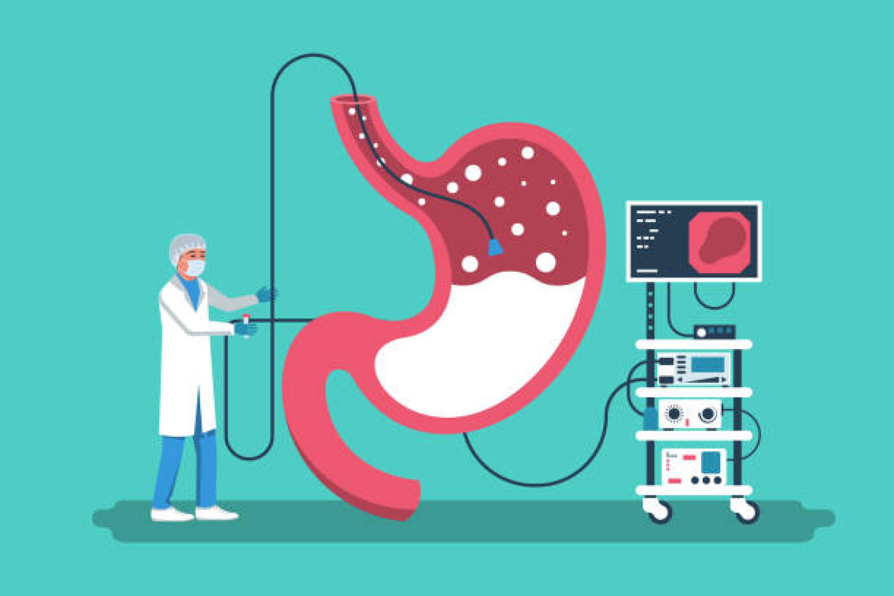 Endoscopie Illustration