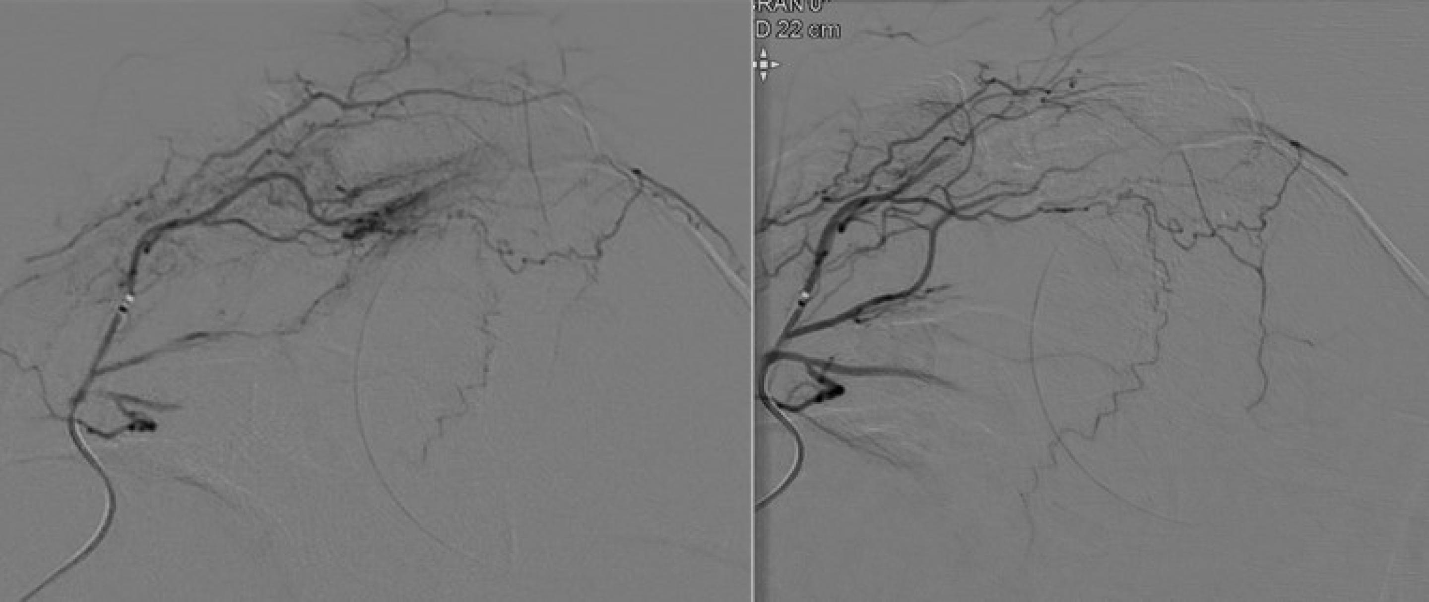 Embolisation de la capsulite rétractile - Hôpital Universitaire de Bruxelles